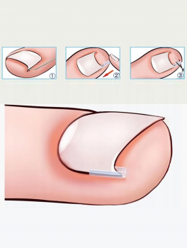 Paski silikonowe na wrastające paznokcie (10 szt)